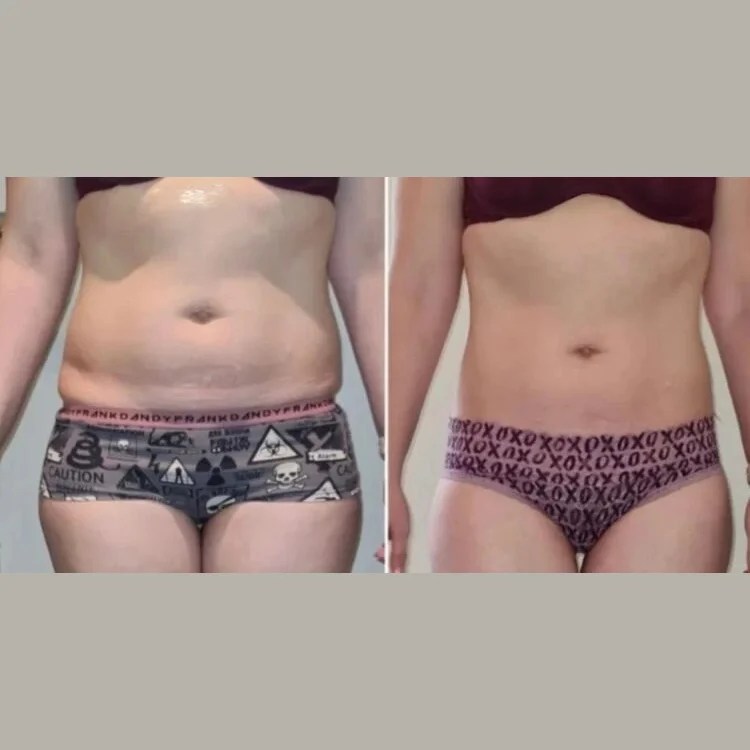 Wonder Axon Before After Treatment at Perfect Drs