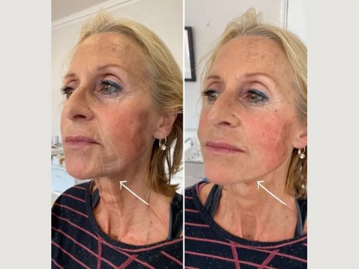 Best Endolift Dubai