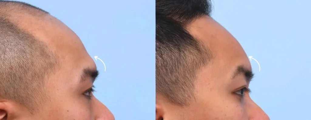 Forehead Fillers Before After Pictures