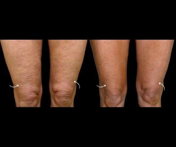 Thermage Results Before and After Dubai