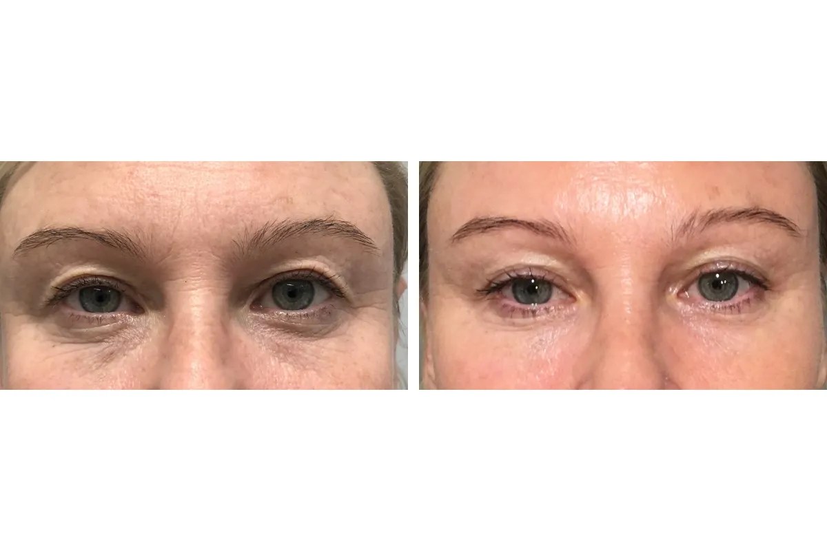 Best Fine Lines Removal Abu Dhabi