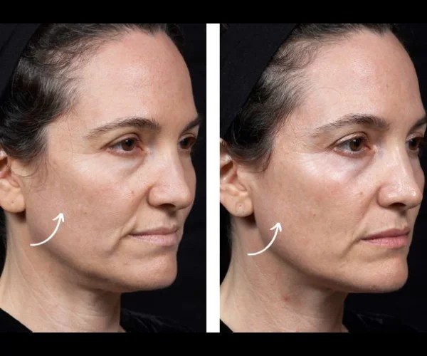 Thermage Facial Rejuvenation Before After Uae