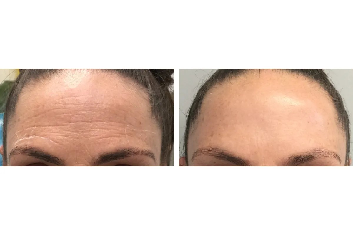 Best Fine Lines Removal Dubai