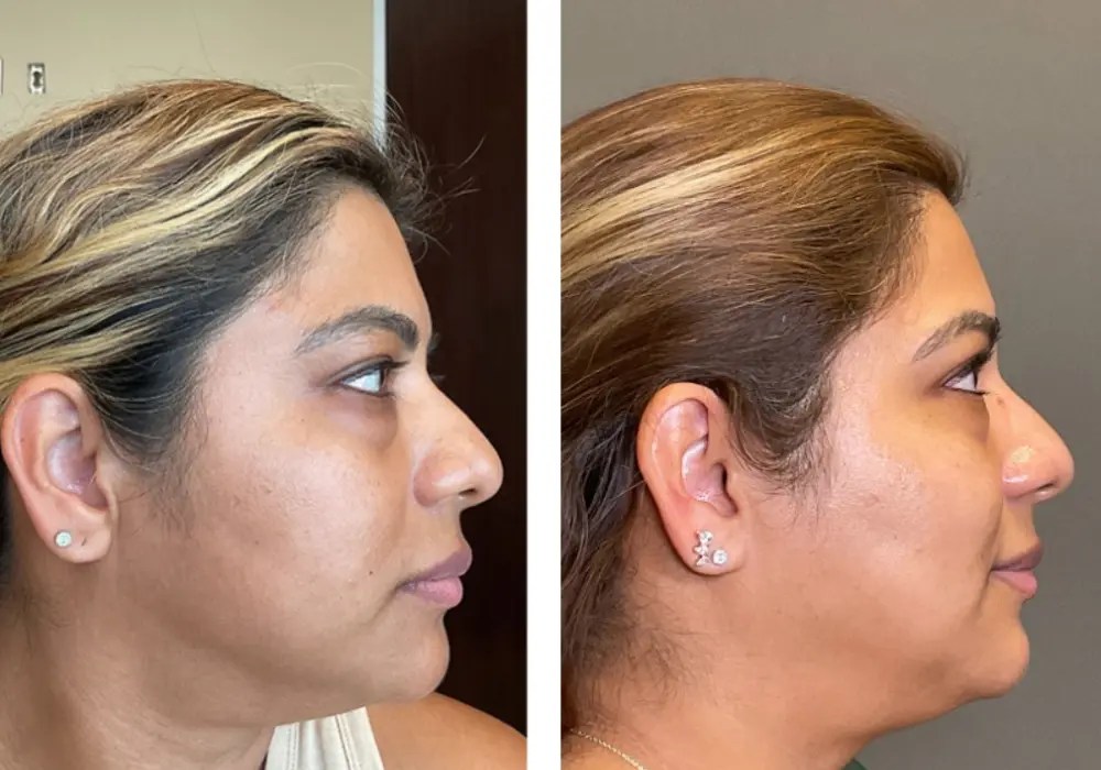 Hydrafacial before and after in uae