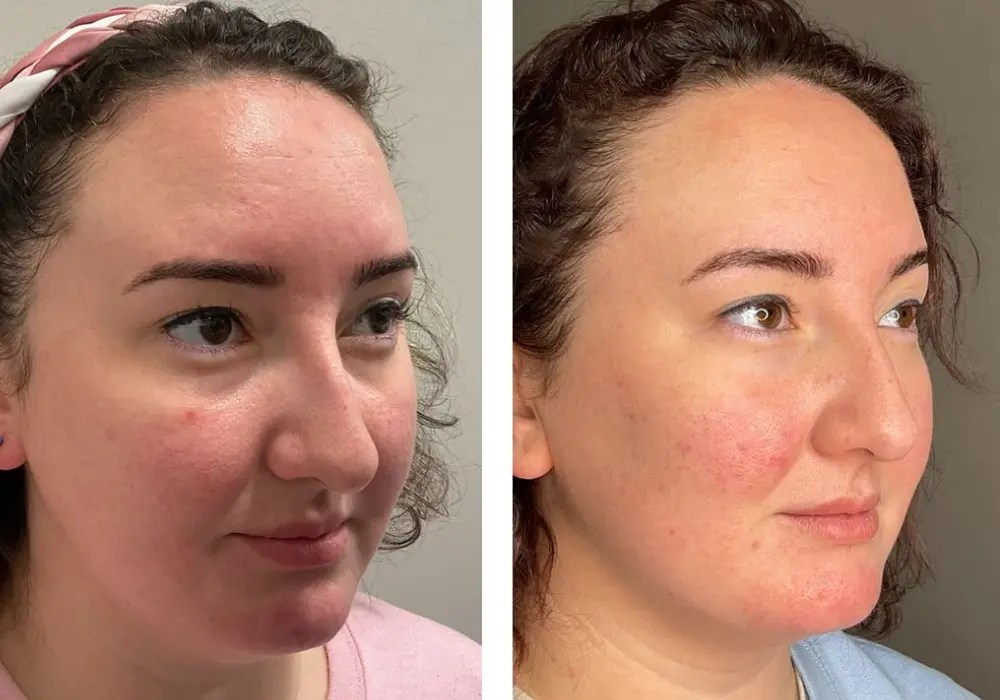 Hydrafacial before and after recovery in uae