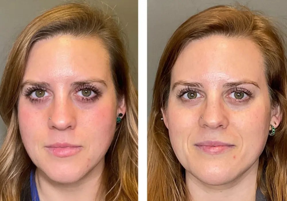 Hydrafacial in dubai
