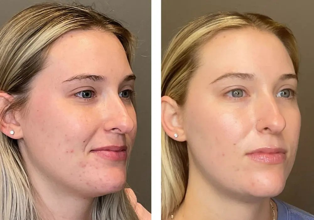 Hydrafacial before and after recovery in dubai