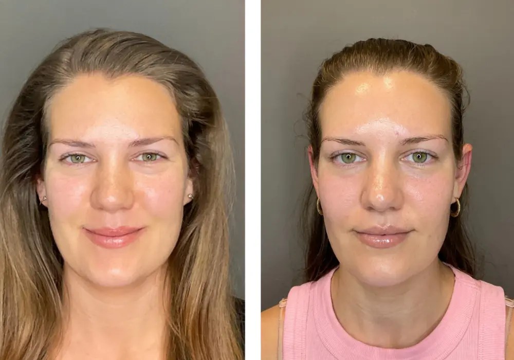 Hydrafacial before and after in uae