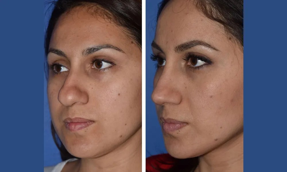 Cosmetic Bulbous Nose Surgery Dubai