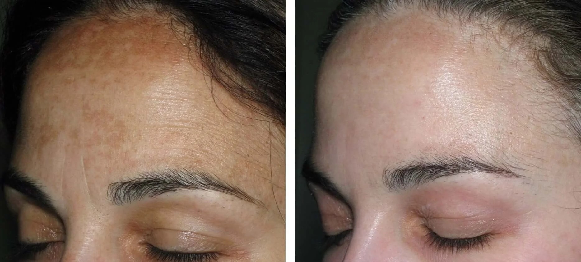 Hyperpigmentation Treatment before after UAE