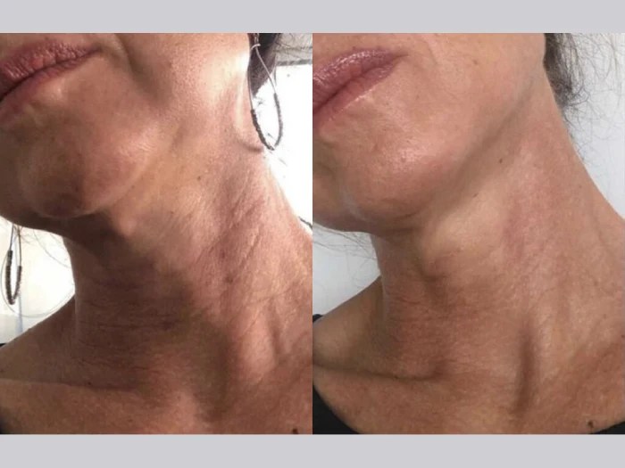 Meso Threads Treatment Dubai