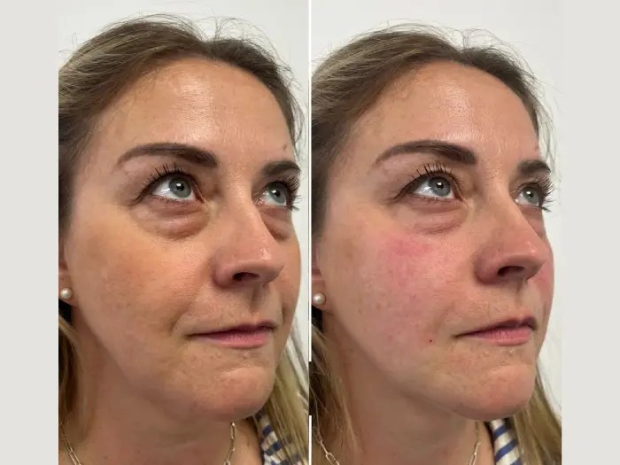 Skin boosters before after dubai