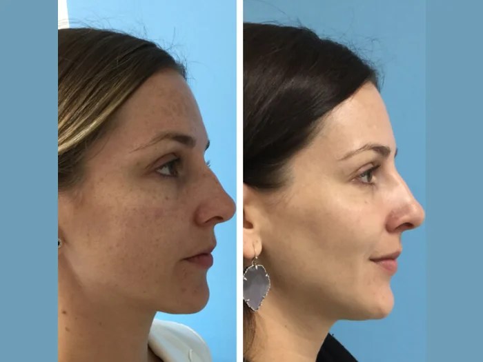 Perfect Drs Anti-Aging IPL Facial