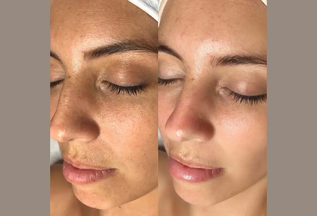 Microdermabrasion Treatment Abu Dhabi