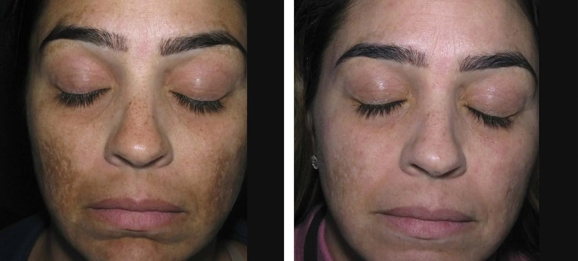 Hyperpigmentation Treatment Abu Dhabi