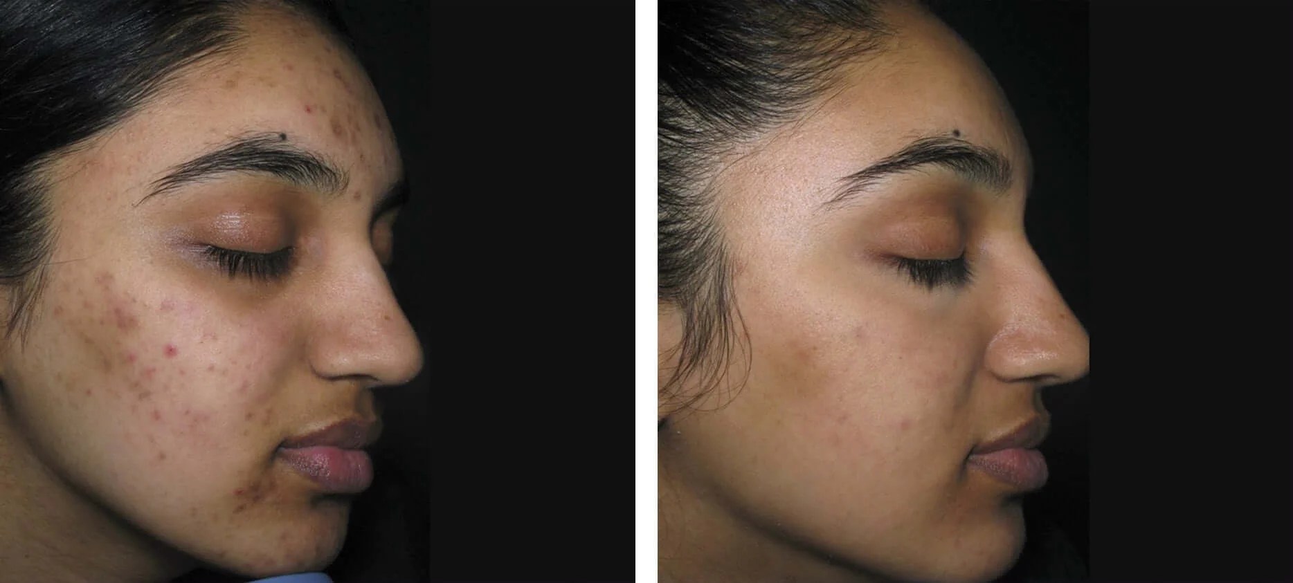 Hyperpigmentation Treatment before after dubai