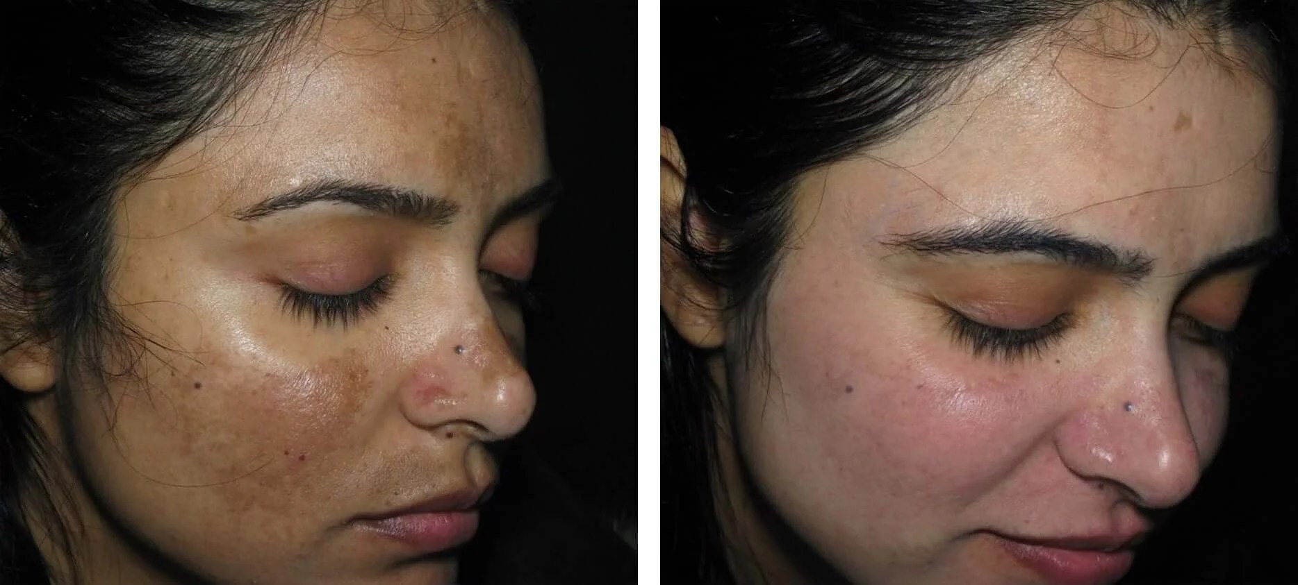Hyperpigmentation Treatment before after dubai