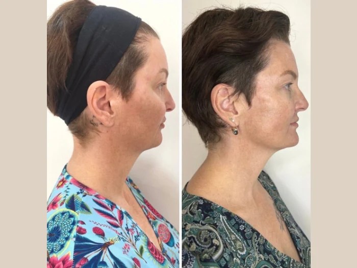 Meso Threads Treatment Abu Dhabi