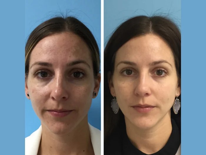 Skin Brightening IPL Photofacial Dubai