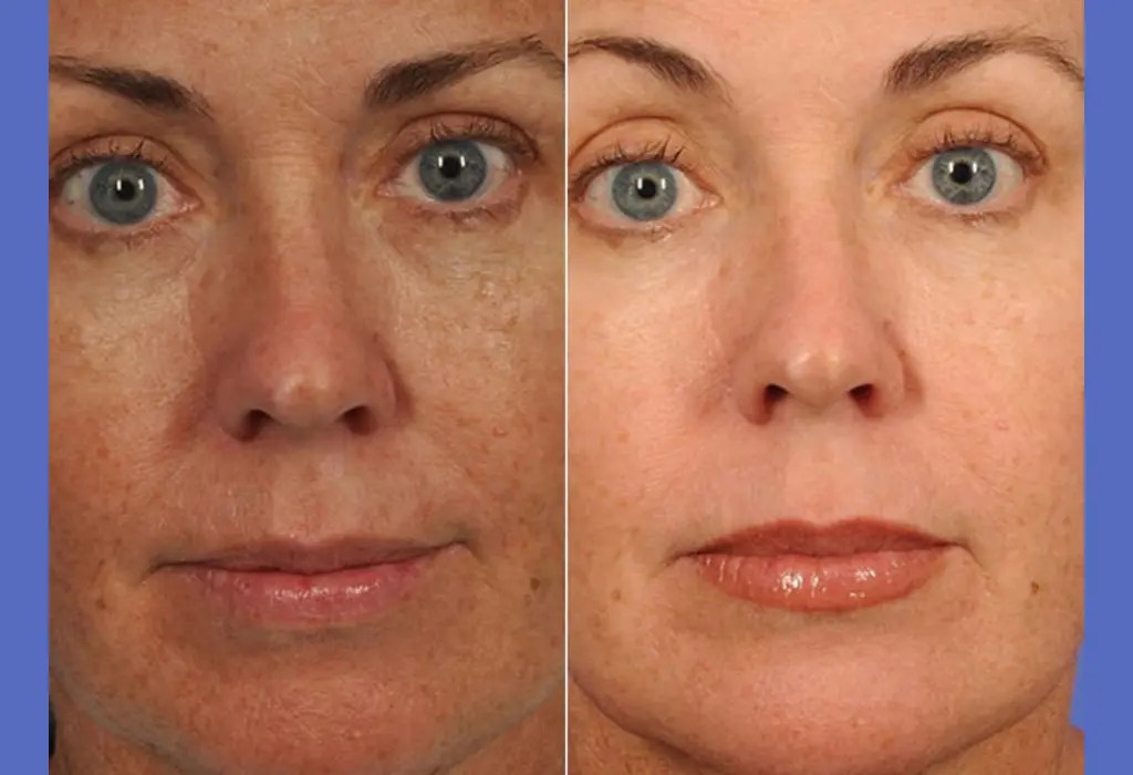 Microdermabrasion Treatment Dubai