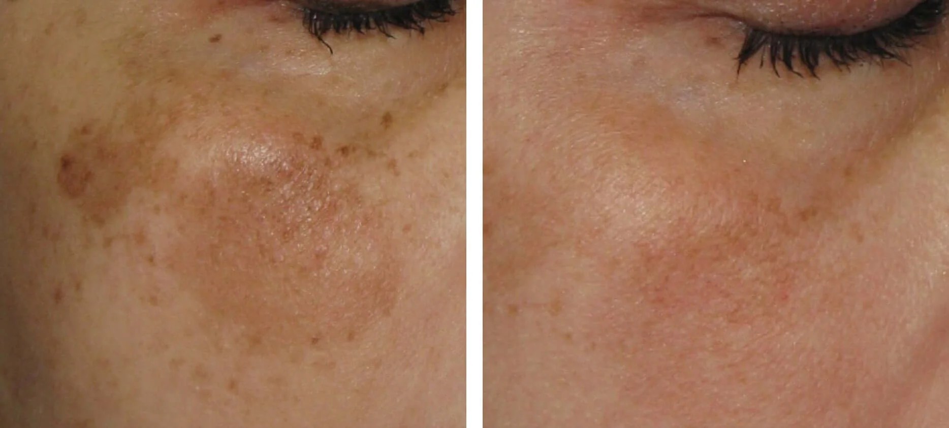 Hyperpigmentation Treatment before after