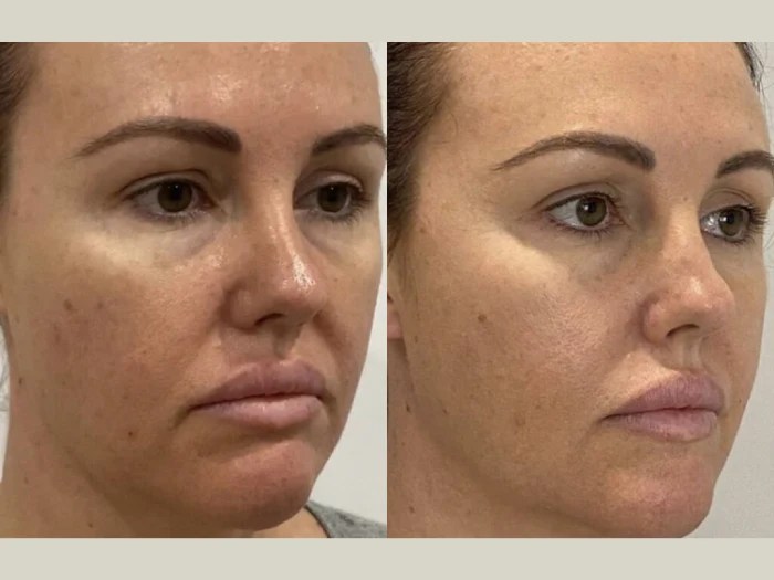 Perfect Drs Meso Threads