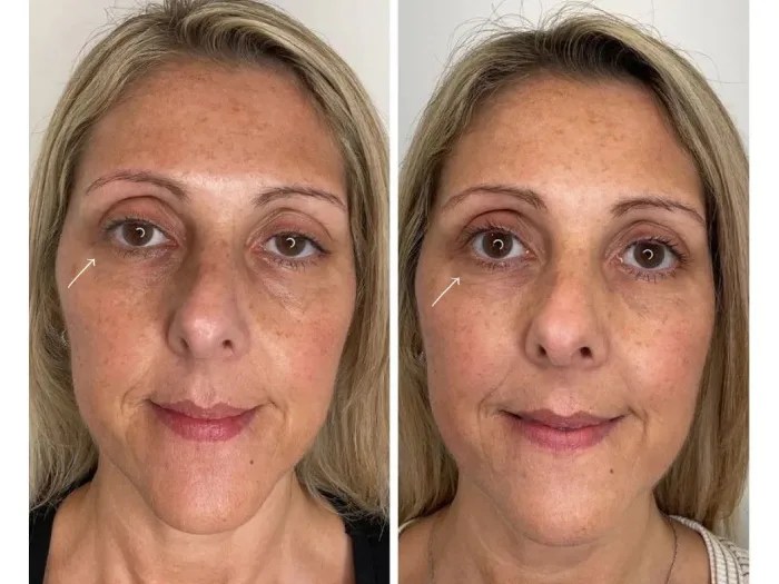 Skin Rejuvenation Sunekos Abu Dhabi