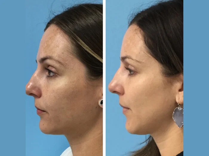 IPL Photofacial Treatment Abu Dhabi