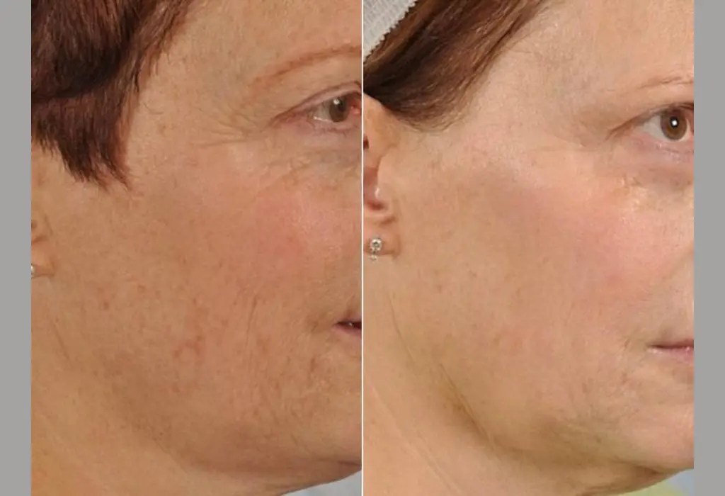Perfect Drs Microdermabrasion Facial