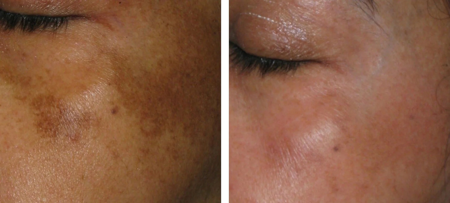 Hyperpigmentation Treatment before after pictures