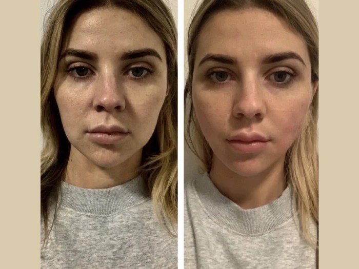 Non-surgical Face Lift with Meso Threads Dubai