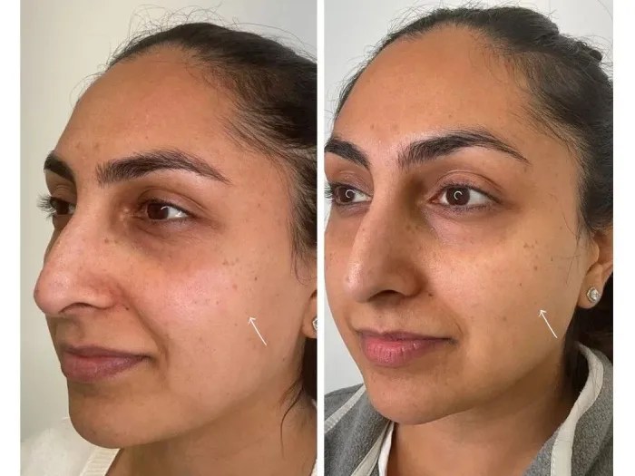 Anti-Aging Sunekos Injections Dubai
