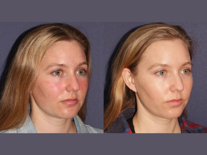 Pigmentation Removal IPL Photofacial Dubai