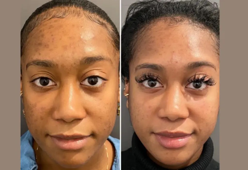 Skin Rejuvenation Microdermabrasion Dubai
