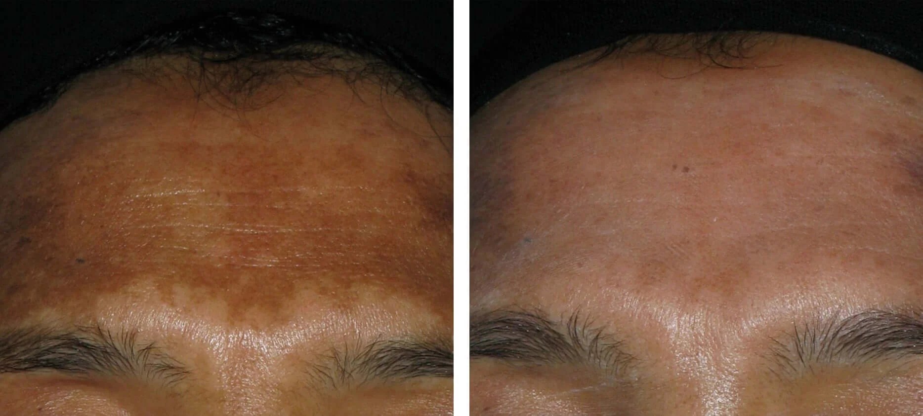 Hyperpigmentation Treatment at Perfect Drs