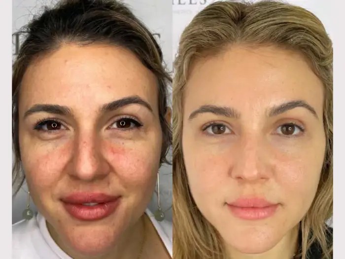 Skin boosters before after results abu dhabi