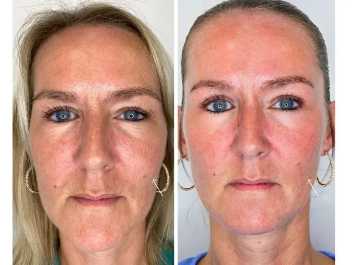 Sunekos Injections Abu Dhabi