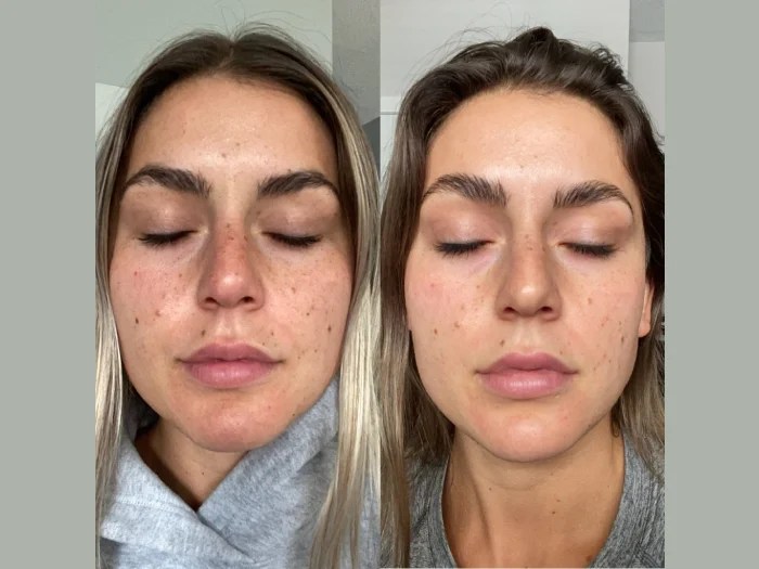 Perfect Drs IPL Skin Rejuvenation