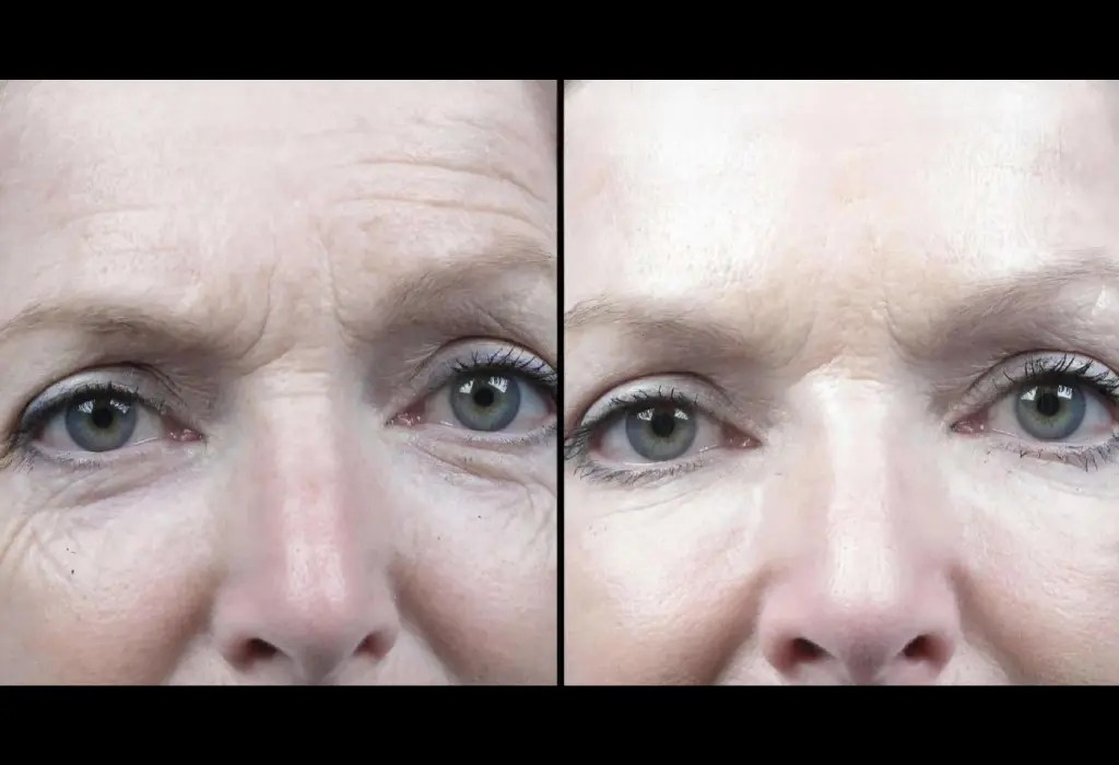 Microdermabrasion for Acne Scars Abu Dhabi