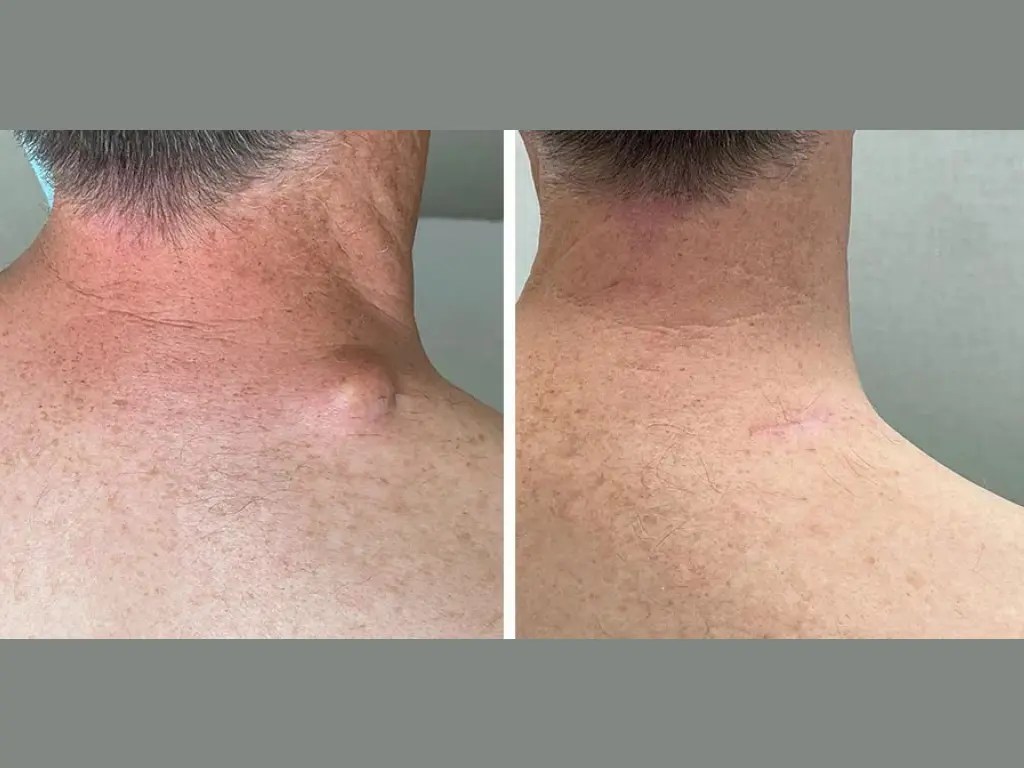 Cyst Removal Treatment Abu Dhabi