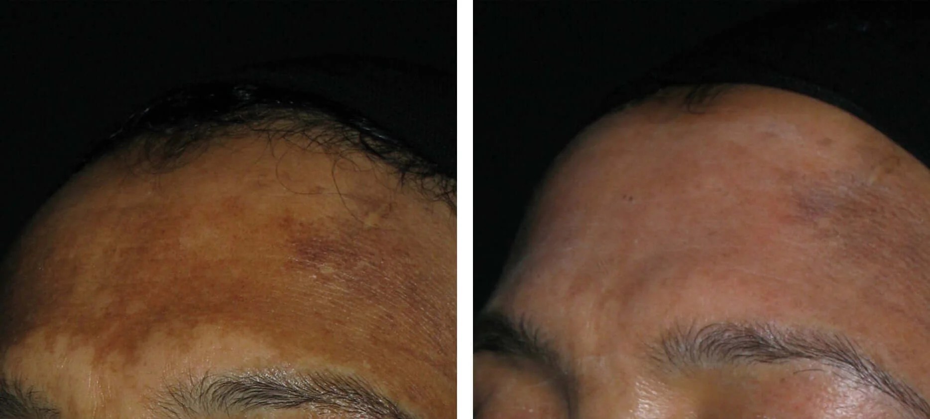 Hyperpigmentation Treatment before after results abu dhabi