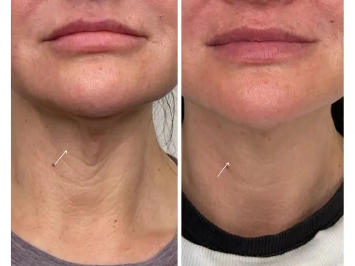 Sunekos Treatment at Perfect Drs