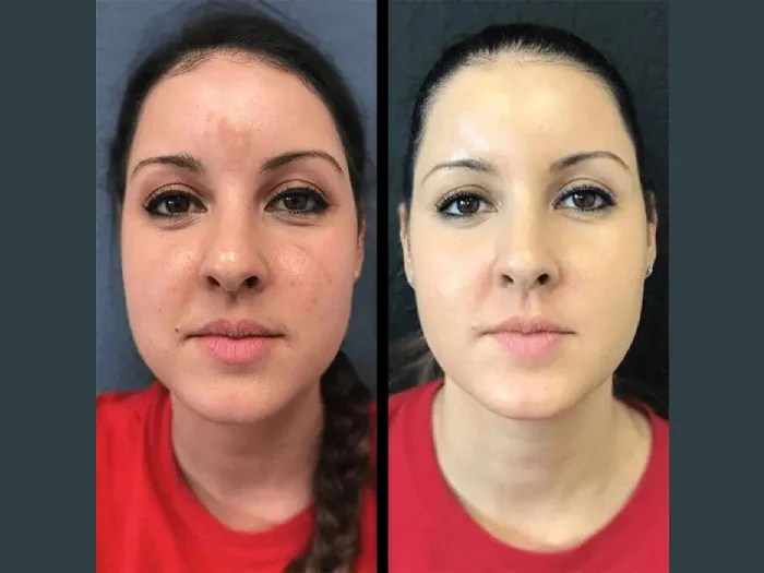 IPL Photofacial Abu Dhabi