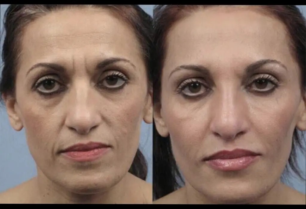 Perfect Drs Advanced Microdermabrasion