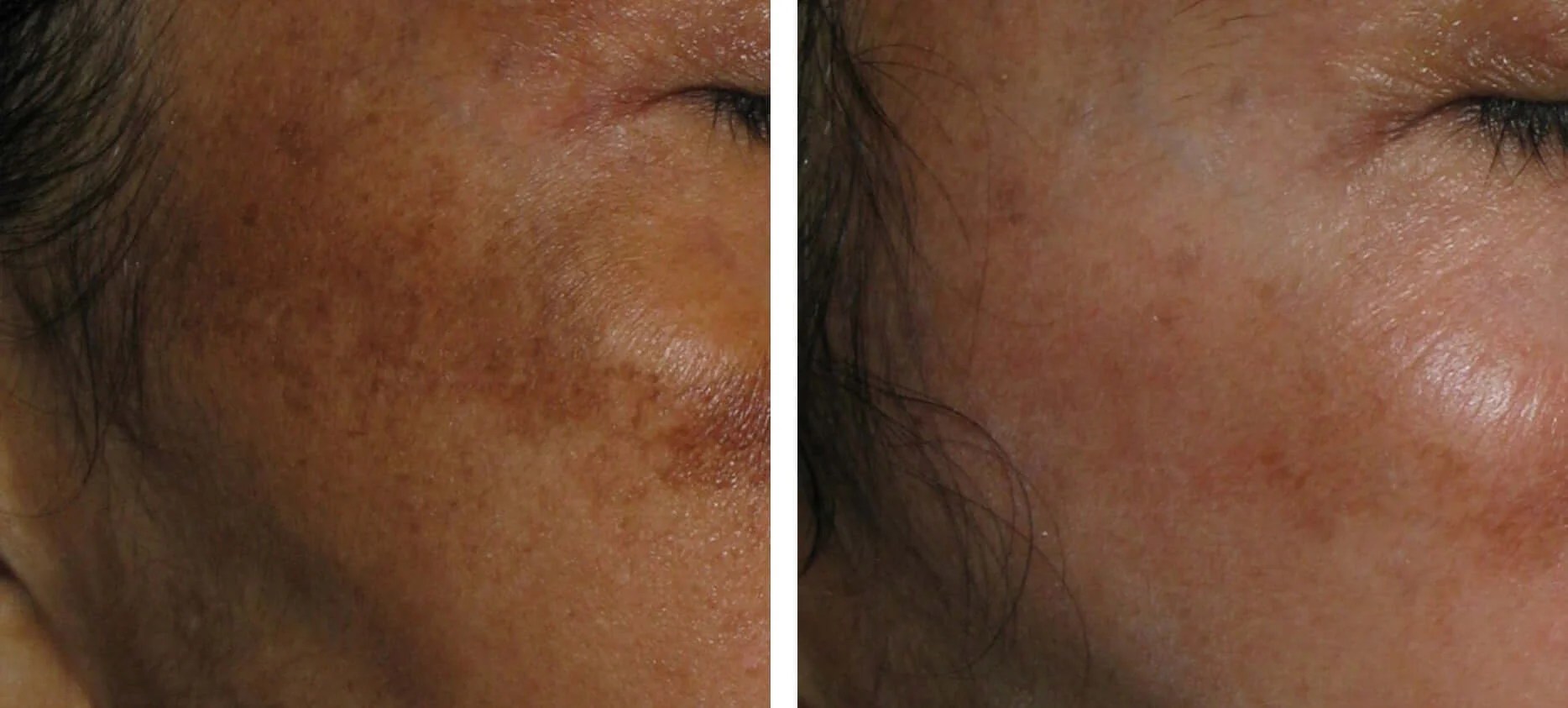 Hyperpigmentation Treatment before after results abu dhabi