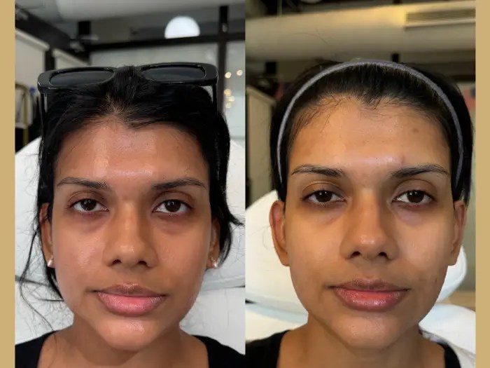 Skin boosters at perfect drs