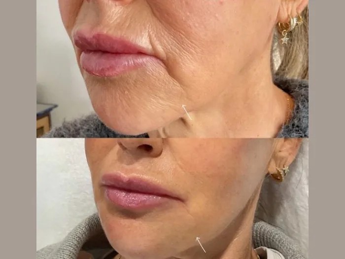 Sunekos Injections Dubai