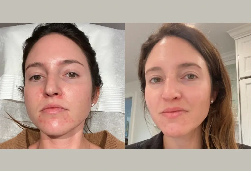 Glowing Skin Microdermabrasion Dubai