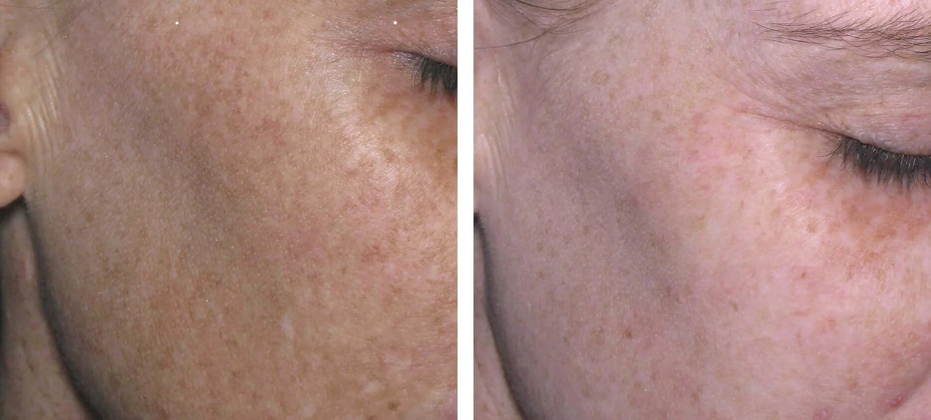 Hyperpigmentation Treatment in UAE