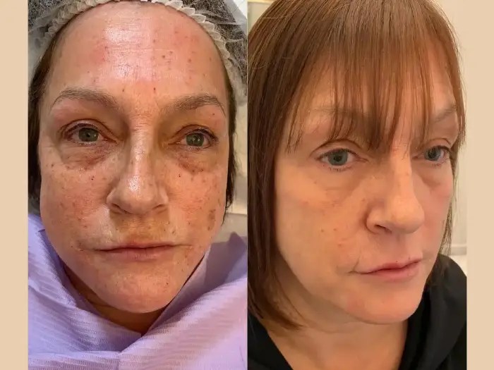 Skin boosters before after pictures